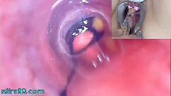 Mature woman peehole endoscope camera in bladder with balls